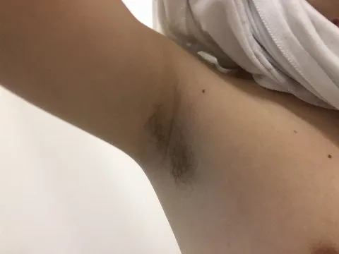 Axillary Hair In Puberty