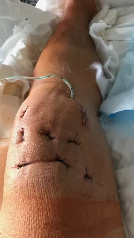 Decollement Am Knie Operiert