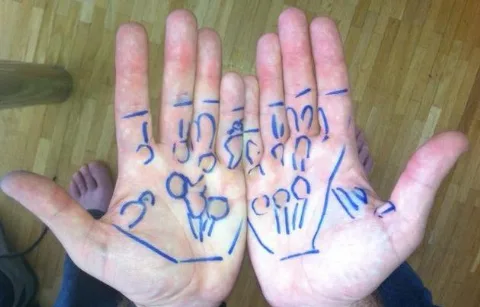 Duputrensdiagnosisseegenschmiedt