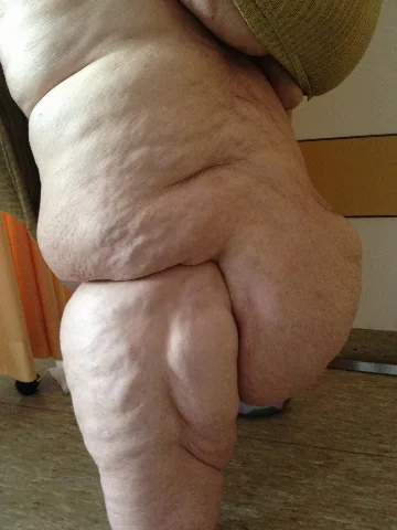 Lipödem