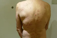 2015.11.26.192551 Cimex Lectularius Bites