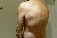 2015.11.26.192558 Cimex Lectularius Bites
