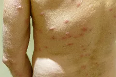 2015.11.26.192605Cimex Lectularius Bites