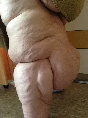 Lipödem