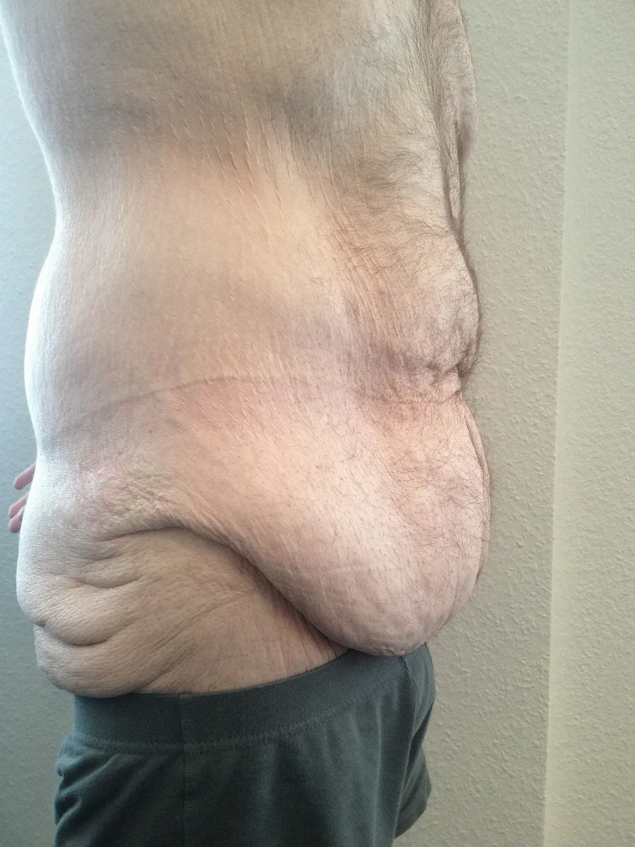 Postbariatric1036